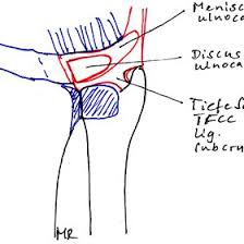 The tfcc is a critical and complex structure that contributes to both load transmission from the in addition to covering the anatomy of the tfcc and the druj along with their functional role in the. Pdf Arthroscopic Treatment For Ulnar Sided Tfcc Tears