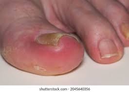 Image result for paronychium