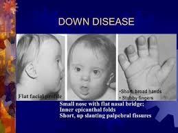 Upslanting palpebral fissures, a suggestion of epicanthal folds, and a flat nasal bridge. Chromosomal Abnormalities Ppt Video Online Download