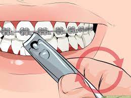 To clip the wire, you can pull back your cheek, dry the area, and with the help of an adult, carefully clip the protruding wire. How To Fix A Broken Braces Wire 6 Steps With Pictures Wikihow