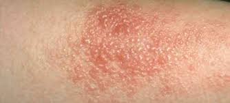 Image result for Eczema nummulare