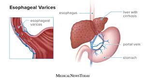 A pulse is often taken at this location. What Are Esophageal Varices Types Treatments And More
