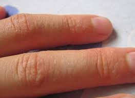 Vodyanistye Voldyri Pa Palcah Ruk I Na Stope Vopros Dermatologu 03 Onlajn