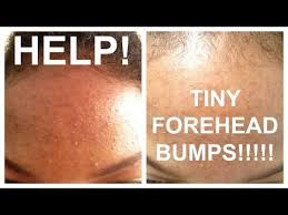 How To Get Rid Of Tiny Forehead Bumps Forehead Bumps Forehead Acne Skin Care Acne