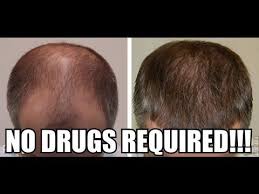 How To Reverse Hair Loss Naturally 294 Reverse Hair Loss Hair Loss Reasons Help Hair Loss