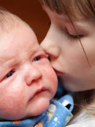 Red flag signs for leukemia or lymphoma include unexplained and protracted pallor, malaise. Cmpa Symptom Eczema In Babies Nhs