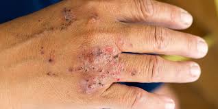 Since less hand washing is not an option for most people, prevention of dry, peeling cuticles is very important. Portland Hand Dermatitis Treatment Norris Dermatology Laser