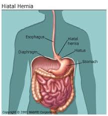 An Overview Of Hiatal Hernia Hiatus Hernia Hiatal Hernia Diet Reflux
