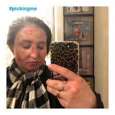 Lauren Mckeaney -Story of Picking Skin Picking Back.