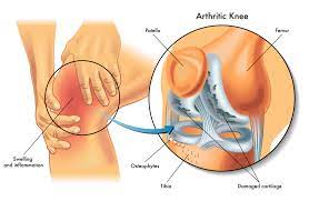 Knorpelaufbau Im Knie Mit Glucosamin Chondroitin Msm