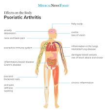8 Effects Of Psoriatic Arthritis On The Body