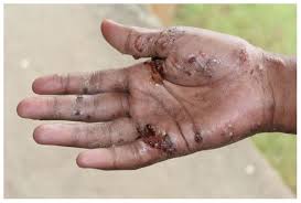 Image result for human scabies