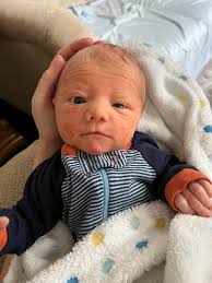 Asher is now three years old, but these pictures are from his first year of  life. His skin has good days and bad days. It appears darker red when he is  warm,