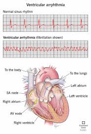 Image result for Ventricular Fibrillation Management in the Adult