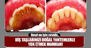 Her yemekten sonra dişleri her tarafı eşit olacak şekilde üç dakika fırçalayarak diş taşlarını daha oluşmadan yok edebilirsiniz. Dis Taslarinizi Dogal Yontemlerle Yok Etmek Artik Mumkun Saglik Haberleri