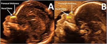 Examples Of Nasal Bone Length And Prenasal Thickness Measurements Download Scientific Diagram
