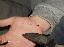 Stab wounds www forensicmed co uk. History Of The Edged Tool Drawing Blood Lore Ravencrest Tactical