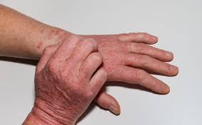 Image result for Hand Dermatitis