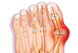 Bunion Pictures Causes Treatments