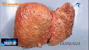 Edemele membrelor inferioare (umflarea ciroza ascita ultima faza. Ficatul Gras Steatoza Hepatica Cauze Diagnosticare Complicatii Ale Bolii Youtube