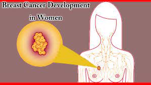 Aaiye aaj hum aapko batate hai, breast cancer symptoms in hindi. Main Causes Of Breast Cancer Development In Women
