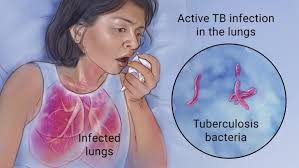 Woman With Actively Infected Lungs Lying In Bed And Coughing Into A Tissue Close Up Of The Tuberculosis Bacteria Prevention Body Organs Tuberculosis