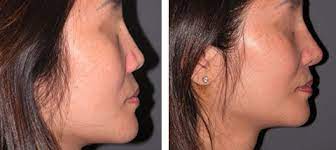 I didnt have any, and its been a year now. Asian Rhinoplasty Asian Nose Job Best Asian Rhinoplasty