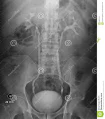 Ivu Xray For Kidney Stones Stock Photo Image Of Expertise 4862334