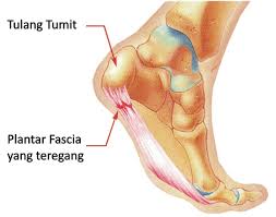 Cara mengatasi sakit tumit secara alami bukanlah hal sulit. Kenapa Tapak Kaki Sakit Bila Pijak Lantai Di Waktu Pagi
