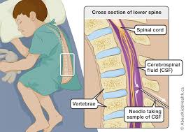 The spine is a long column of bones called vertebrae that run all the way along an animal's back. Leukemia And Lumbar Puncture