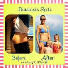 Pin On Diastasis Recti C Section Tummy Tuck