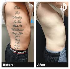 We still recommend the laser tattoo removal method. 7 Factors That Determine The Cost Of Your Tattoo Removal Tattoo Cares