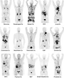 Keep this in mind when reading about cancer. Novel Radiotracer 68ga Fapi Can Identify 28 Different Types Of Cancer With Pet Ct Image Shows Just 15 Different Cancers Radiology