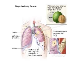 non small cell lung cancer program in cleveland oh