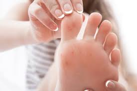 Download foot warts images and photos. Plantar Warts Facts Causes Symptoms Diagnosis Treatment Factdr