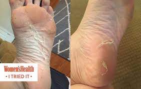 See full list on wikihow.com Baby Foot Peel I Tried It And Here S What Happened Women S Health