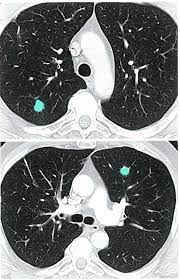 A ct scan can help detect a wide range of abnormalities or disease, including cancer, in any part of the body. Breast Cancer Knowledge Amboss