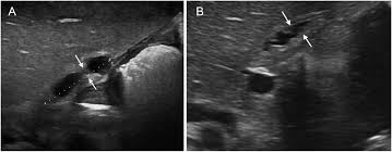 Maybe you would like to learn more about one of these? Is Gallbladder Length To Width Ratio Useful In Diagnosing Biliary Atresia Journal Of Pediatric Surgery