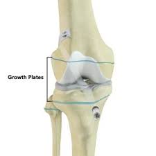 An acl surgery requires precise knowledge of the anatomy of the knee, attachment sites of the acl and knowledge on the other ligaments and structures of the knee. Transphyseal Surgery Boston Transphyseal Acl Reconstruction Atlanta San Diego New York City