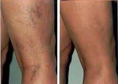 Depilitè es la clínica de belleza especializada en depilación láser. Como Hacer La Depilacion Laser En Casa