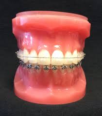 Check spelling or type a new query. Types Of Braces Ceramic Braces Charleston Orthodontic Specialists