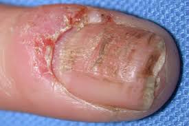 Image result for Pitting nails feet