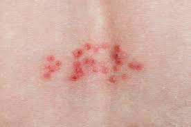 The sooner you get into a doctor, the better possibility you will be able to get the shot that lessens the pain. Shingles Self Care Mydr Com Au