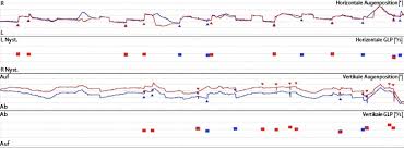 Schwindel Durch Larm Oder Druck Auf Dem Linken Ohr Springerlink