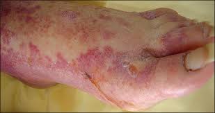 Angioimmunoblastic — an·gio·im·mu·no·blas·tic (an″je o im″u no blasґtik) characterized by the presence of immunoblasts (lymphoblasts) and an inflammatory infiltrate in small blood vessels. Pathology Outlines Angioimmunoblastic