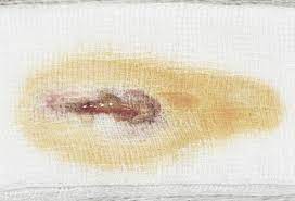 Once trapped underneath the skin, the ingrown hair can lead to soreness, redness, and inflammation. Boils Pictures Causes Symptoms And Treatment