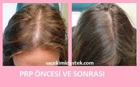 Sac Mezoterapisi Yaptiranlar