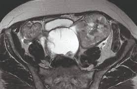 A sum mary of the ﬁndings is. What To Do With Incidental Ovarian Cysts Pulse Today