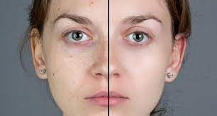A Complete Guide To Digital Makeover In Photoshop Blemish Remover Blemish Free Skin Photoshop