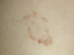 Penyakit kulit yang kronis seperti eksim dan psoriasis merupakan salah satu penyakit kulit yang sering dihadapi oleh masyarakat di indonesia. 12 Penyakit Kulit Yang Sering Menyerang Anak Anak Theasianparent Indonesia